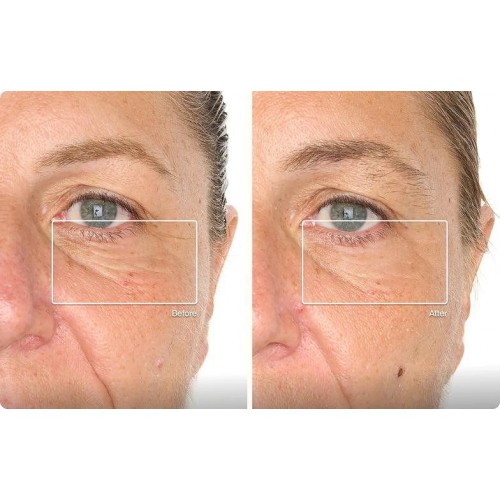 TheraFace Mask Glo - ICE Facial Mask | Vibration Therapy