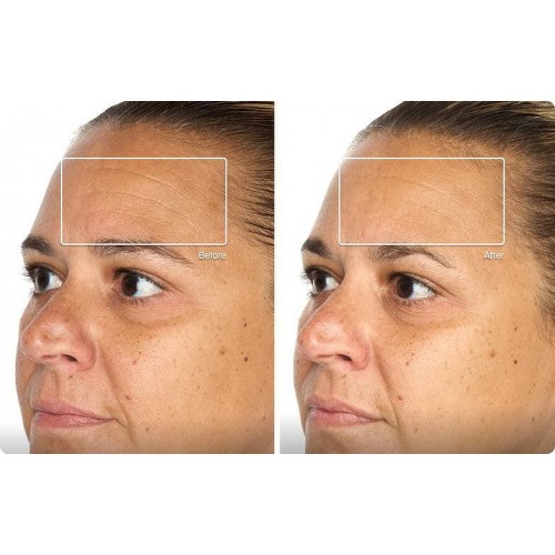 TheraFace Mask Glo - ICE Facial Mask | Vibration Therapy
