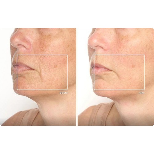 TheraFace Mask Glo - ICE Facial Mask | Vibration Therapy