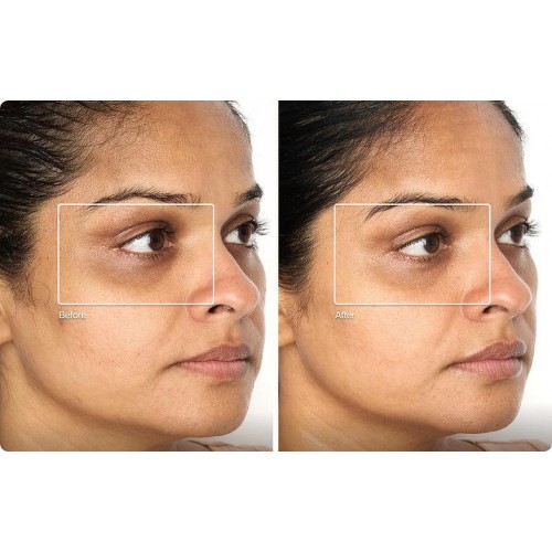TheraFace Mask Glo - ICE Facial Mask | Vibration Therapy