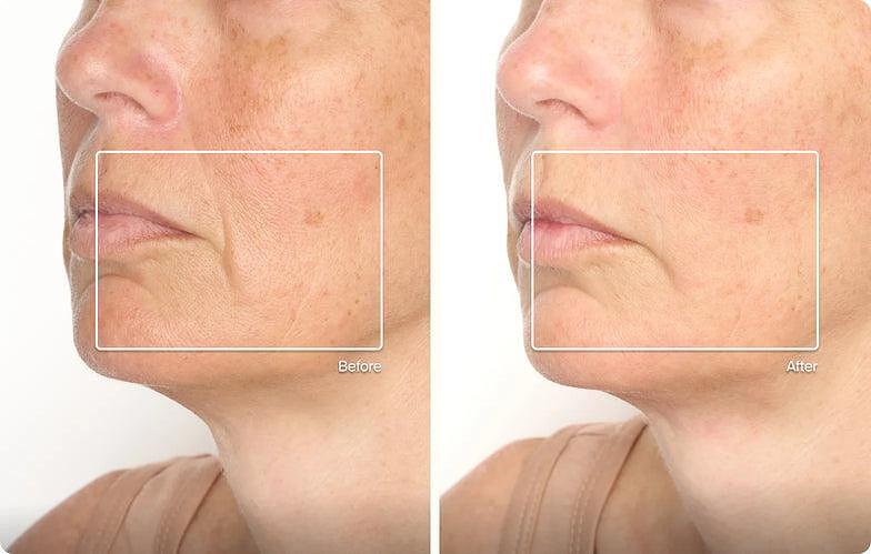 TheraFace Mask Glo - ЛЕД Маска за Лице | Вибрационна терапия